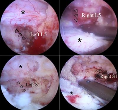 Case Report: Five-Level Unilateral Laminectomy Bilateral Decompression (ULBD) by Two-Stage Unilateral Biportal Endoscopy (UBE)